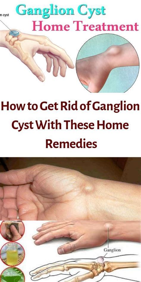 Ganglion Cysts Are Small Lumps Within The Hand And Wrist That Occur