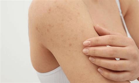 Keratosis Pilaris All You Should Know About This Common Skin Condition