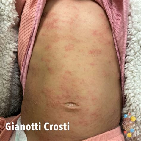 Gianotti Crosti Syndrome Skin Deep