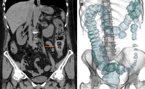 Rare Case Of Fecal Impaction Caused By A Fecalith Originating In A