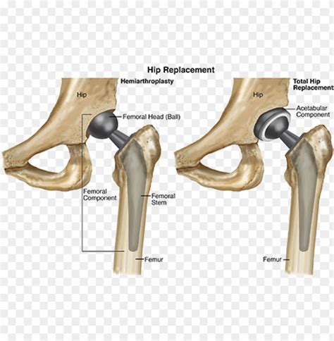 Hemiarthroplasty Vs Total Hip Replacement Png Transparent With Clear