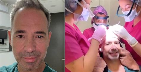 José Gaudet sort et partage toutes les photos de sa greffe de cheveux
