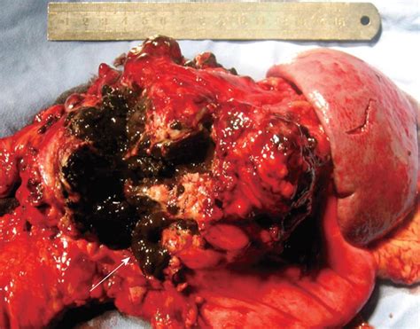 Isolated Pancreatic Metastasis From Malignant Melanoma A Case Report