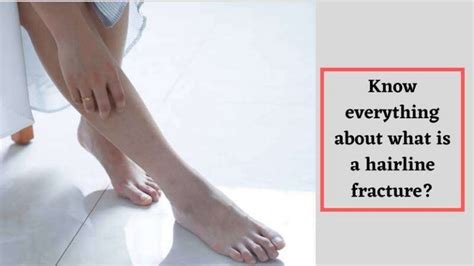Know Everything About What Is A Hairline Fracture