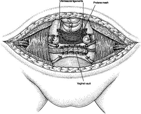 Vaginal Vault Suspension For Prolapse After Hysterectomy Using An Autologous Fascial Sling Of