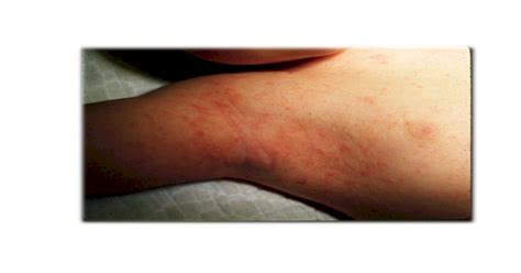 Scabies Home Remedies How Can You Get Scabies Medication For Scabies