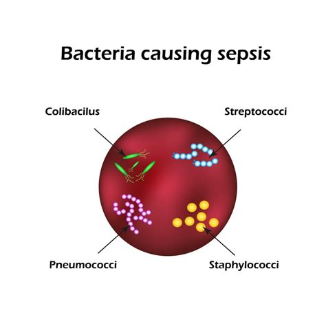 Scegli uno specialista che se ne occupa e prenota una visita. Setticemia: i sintomi, le cause e le differenze con la ...