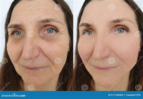 Woman Wrinkles Before After Sagging Treatment Pigmentation Stock Image