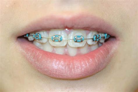 Baby Blue Chain Braces Great Band Blogger Photo Galery
