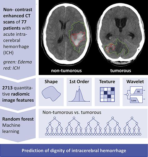 Frontiers Neoplastic And Non Neoplastic Acute Intracerebral