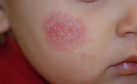 Dry Patches On Skin Atopic Dermatitis Symptoms