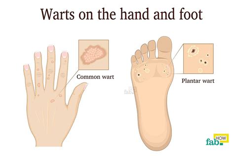 Warts And All