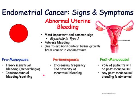 Solution Endometrial Cancer Signs And Symptoms And Why They Occur 1