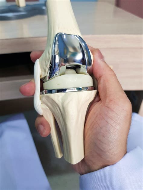 Total Knee Replacement Surgery Melbourne — Mr Sam Patten Melbourne Orthopaedic Surgeon