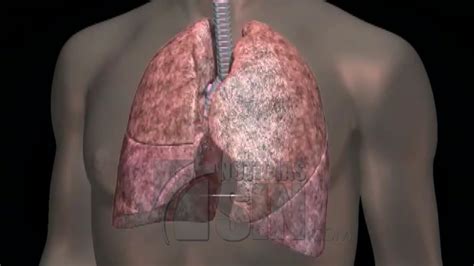 Qu Es La Fibrosis Pulmonar Y Cu Les Son Sus Principales S Ntomas 48128