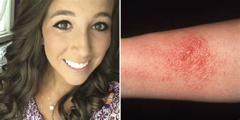 You Have To See What Happened When This Girl Got Poison Ivy In Her Eyes