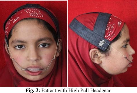 Figure From Maxillary Growth Control With High Pull Headgear A Case Report Semantic Scholar