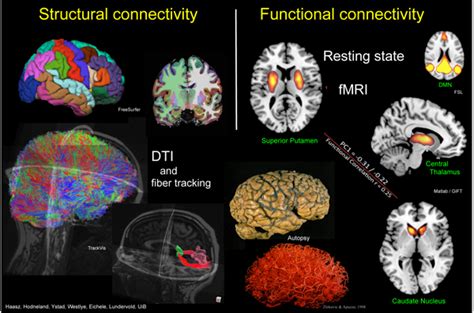 Structural And Functional Connectivity Assessed With Multimodal Mri Download Scientific Diagram