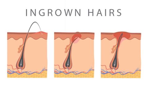 Ingrown hairs are also more likely to happen if you don't follow a proper shaving regimen: Ingrown hairs - What causes them and how to treat them ...