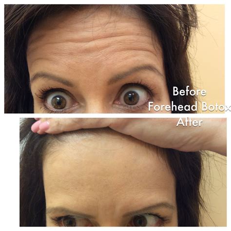How Often To Get Botox In Forehead