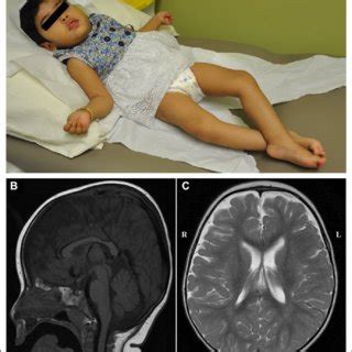 The epicanthic fold produces the eye shape characteristic of persons from central and eastern asia; (PDF) PRUNE Syndrome Is a New Neurodevelopmental Disorder ...
