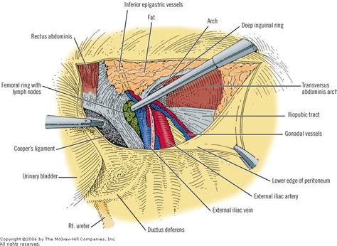 Print Chapter Abdominal Wall And Hernias In Hernia Repair