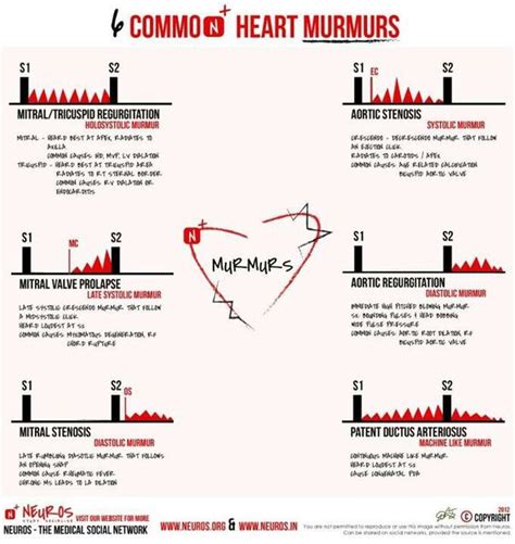What Are Heart Murmurs Causes Symptoms And Treatment Health Life Media