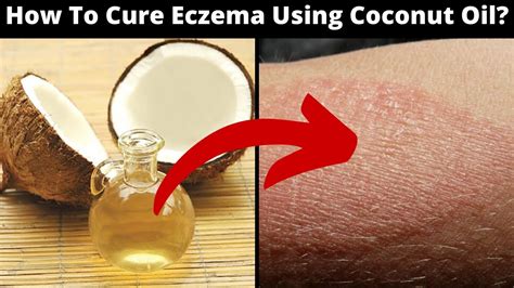 How To Cure Eczema Or Dermatitis Permanently Using Coconut Oil 5