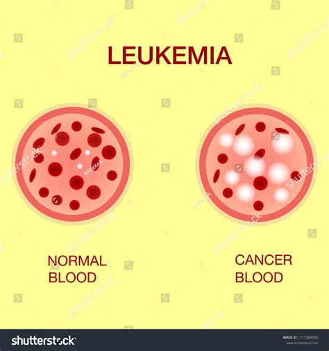 Infographic Image Leukemia Leukaemia Disease Awarenessleukemia Stock