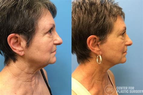 Neck Lift Before And After Photo Gallery Annandale Washington Dc