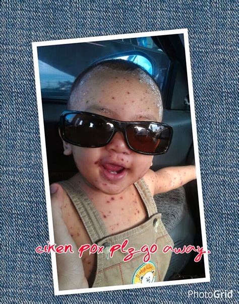 Tidak susah nak hilangkan parut demam campak chicken pox ini. IbuUmarArryanPapa