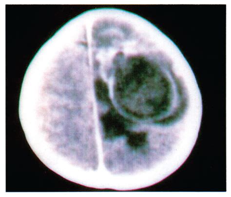 Brain Abscess Due To Staphylococcus Aureus Following Neonatal Breast