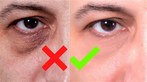 How To Remove Dark Circles Under Your Eyes Mens Skin Care Youtube