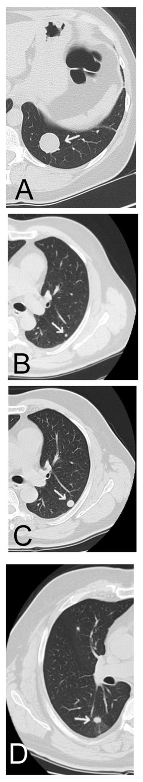 jcm free full text clinical and radiologic features together better predict lung nodule