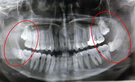 Cureus Bilateral Dentigerous Cyst In Impacted Mandibular Third Molars