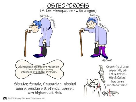1000 Images About Osteoporosis On Pinterest Bone Health 100