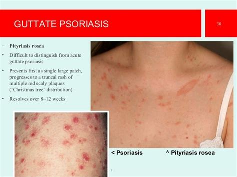 Psoriasis The Best Presentation