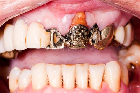 Il figure parmi les solutions qui vous aideront à retrouver le sourire ! Very old dental bridge stock image. Image of plaque, metal ...
