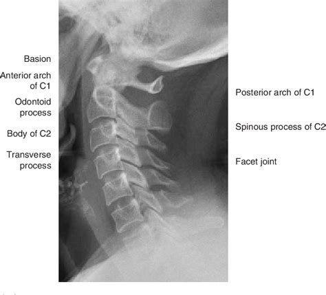 Figure 1 From The Radiological Assessment Of Injuries To The Atlanto