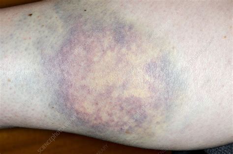 Bruise On The Leg Stock Image C0169306 Science Photo Library