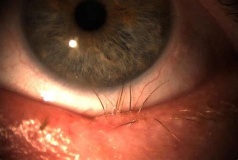 Trichiasis Or Ingrown Eyelash Definition Causes Surgery