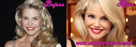 Christie Brinkley Plastic Surgery Pictures