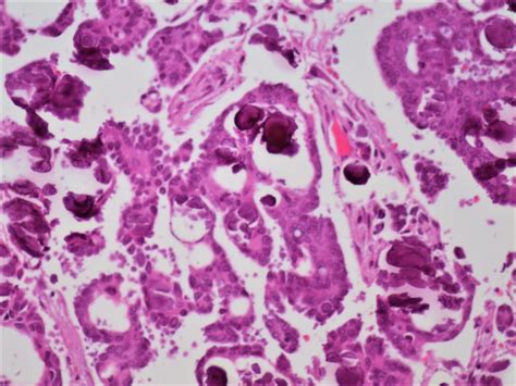 Pathology Outlines Calcification