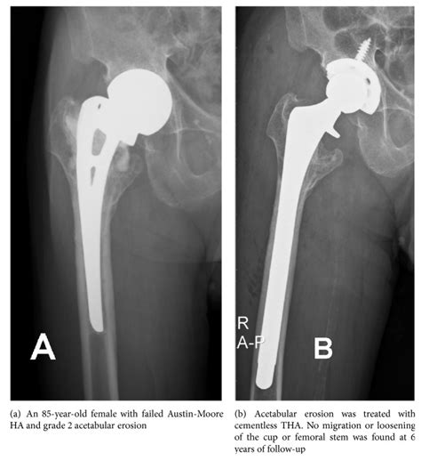 Bipolar Hemiarthroplasty Vs Total Hip Replacement