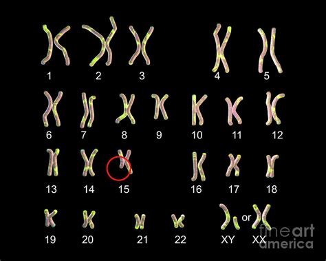 Karyotype Of Angelman Syndrome Photograph By Kateryna Kon Science Photo