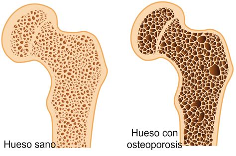La Osteoporosis Centro Fisioterapia Majadahonda