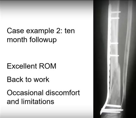 Reduction Techniques In Tibial Shaft Fractures —