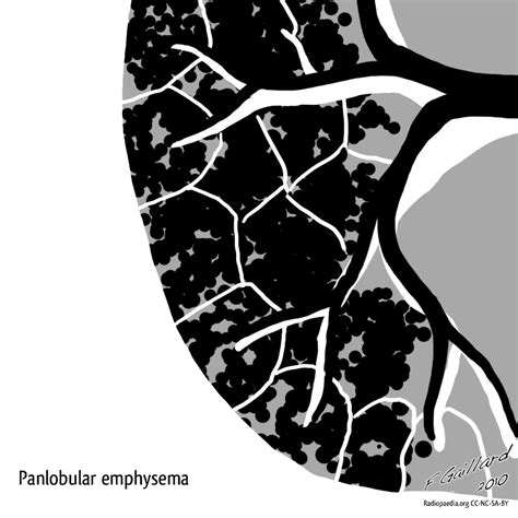 Emphysema Diagrams 2 Pinkybone