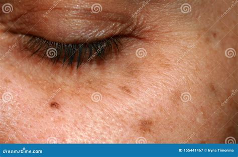 Brown Melanoma Angioma Or Birthmark Woman Dark Skin Texture Royalty