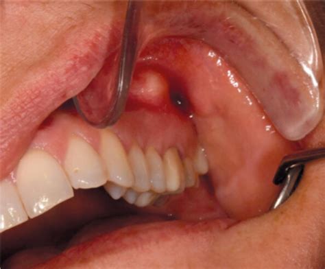 Bacterial Odontogenic Infections 2023